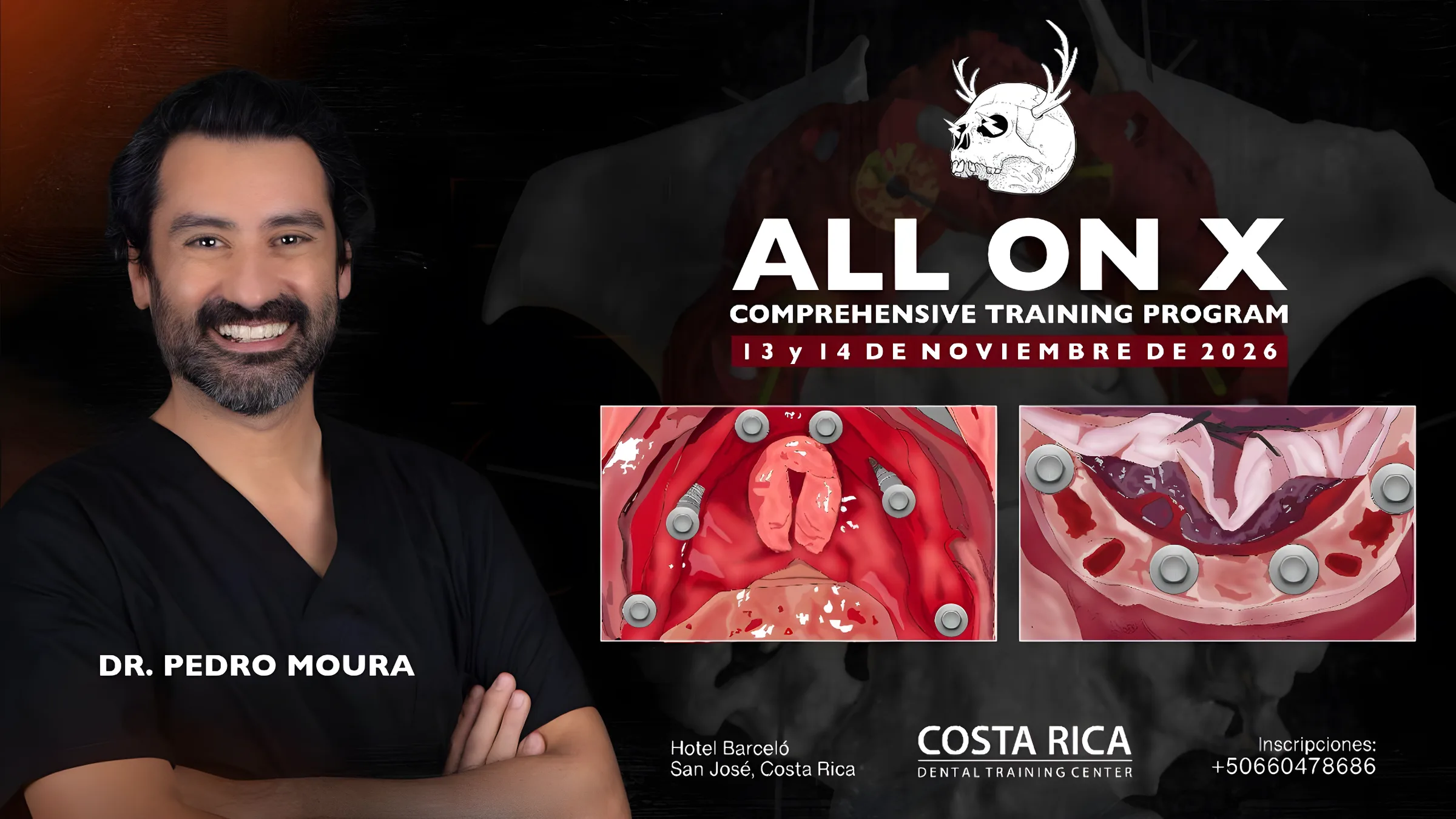 Detalle del curso ALL ON X, Comprehensive Training Program, con Dr. Pedro Moura — 13 y 14 de noviembre de 2026