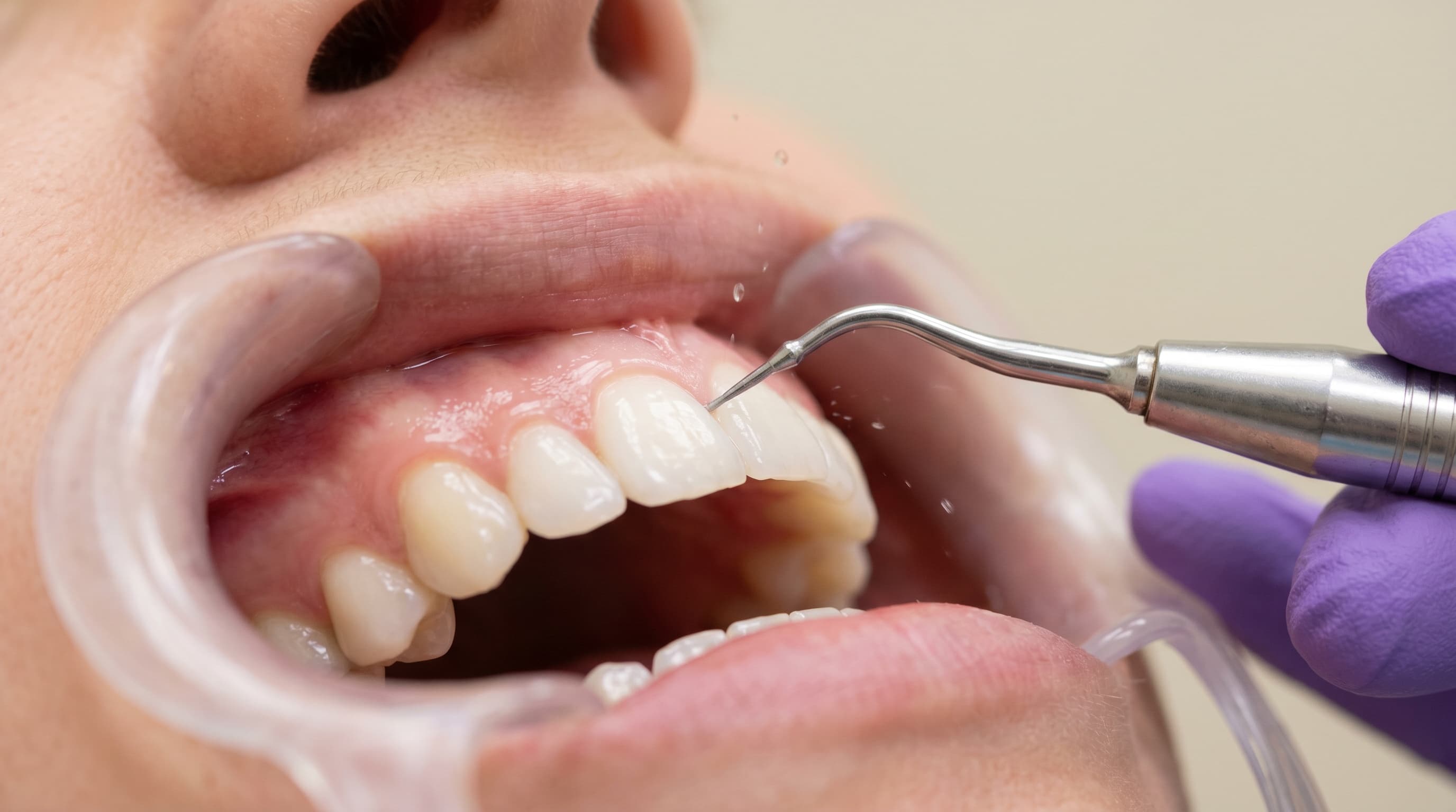 Limpieza Dental