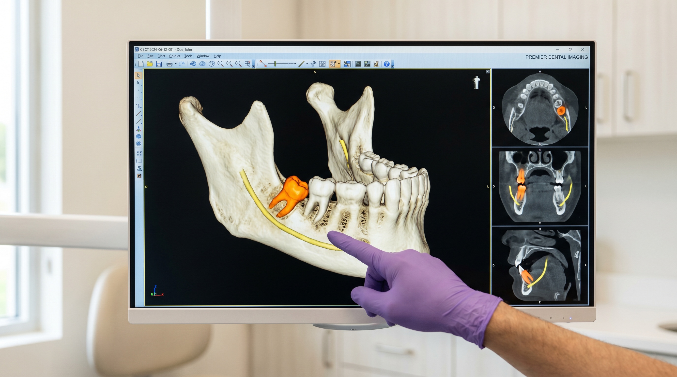 Cirugía de Dientes Retenidos